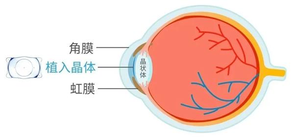 合肥普瑞专家提醒：不是人人都能做，近视手术的最佳年龄及度数