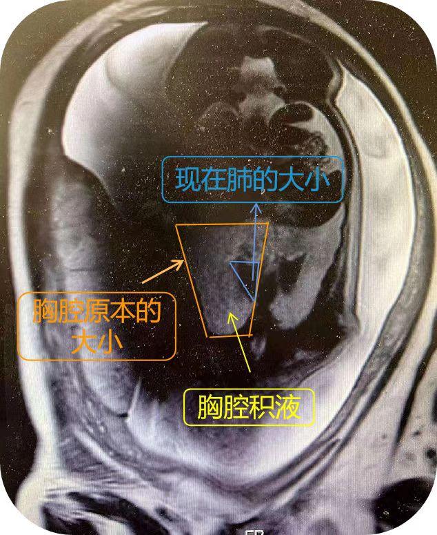 未出生的宝宝胸腹腔大量积液！8分钟内，新华上演母胎脐带相连下的罕见分娩