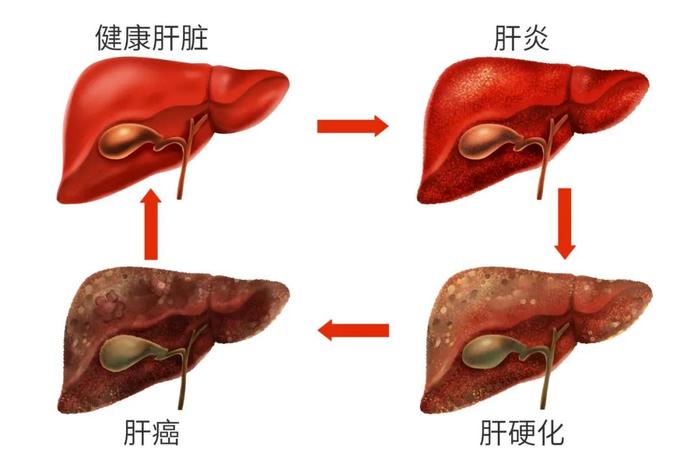 “乙肝”一定会发展为“肝癌”？如何避免很关键！