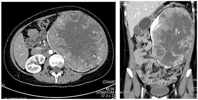 左肾肿瘤大小如同40码鞋！女大学生在新华“拆弹保肾”