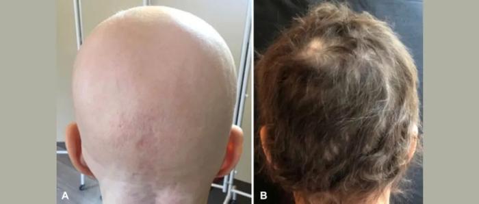 近4成患者恢复80%头发，礼来公司口服斑秃药物在中国获批上市