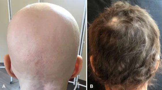 近4成患者恢复80%头发，礼来公司口服斑秃药物在中国获批上市