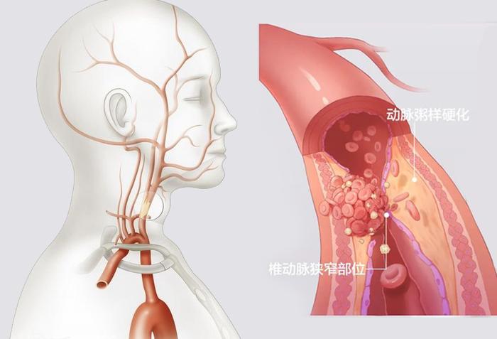 高难度椎动脉血管支架植入术，打通“命悬一线”的狭窄血管