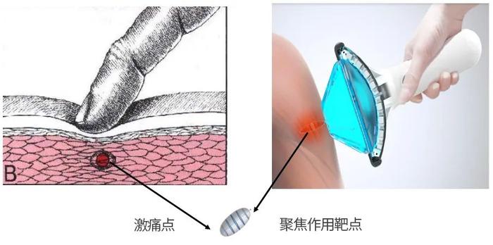 压电式聚焦冲击波在肌筋膜疼痛中的临床应用