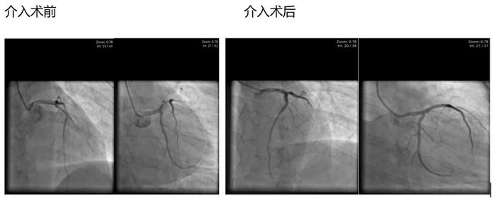 活心丸（浓缩丸）治疗病例之72—急性ST段抬高型前壁心肌梗死的男性患者