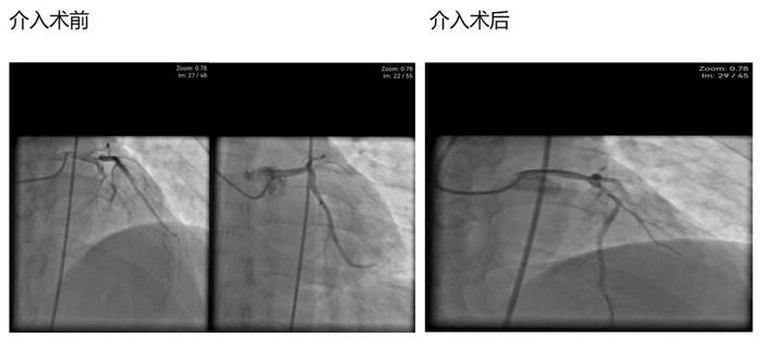 活心丸（浓缩丸）治疗病例之72—急性ST段抬高型前壁心肌梗死的男性患者