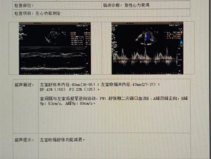 活心丸（浓缩丸）治疗病例之73—急性心衰的老年女性患者