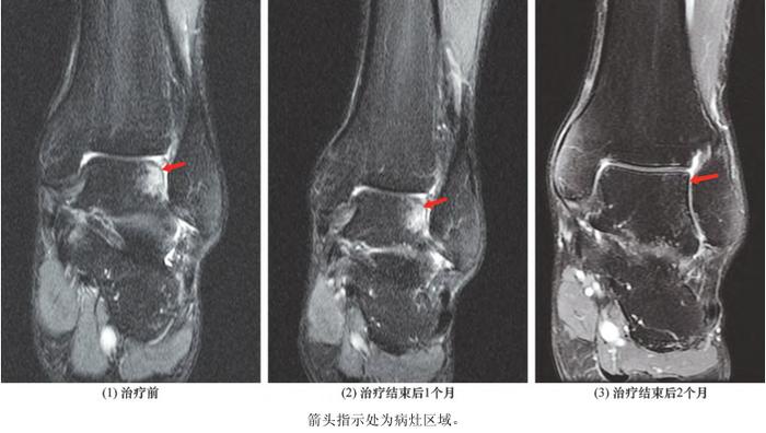 体外冲击波疗法在距骨软骨损伤中的临床作用研究