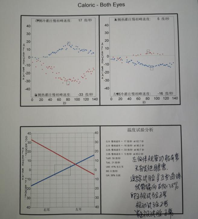 悦康通悦耳优秀病例3：糖尿病患者突发性聋