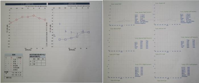 悦康通悦耳优秀病例3：糖尿病患者突发性聋