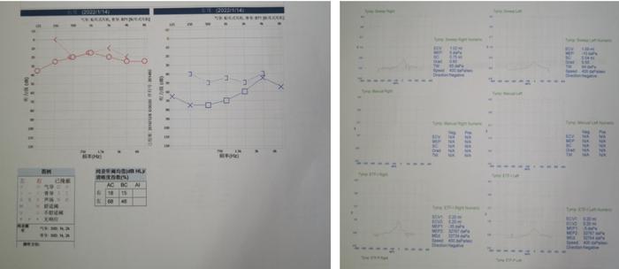 悦康通悦耳优秀病例3：糖尿病患者突发性聋