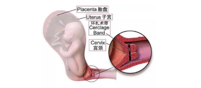 河北生殖妇产医院专家谈：宫颈机能不全怕早产？宫颈环扎是出路！