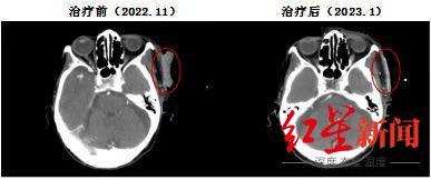 “老年斑”竟是恶性肿瘤，108岁老人成功抗癌！医生：她很乐观也配合治疗