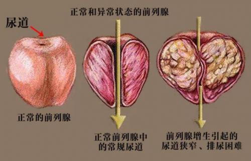 前列腺增生三分靠治疗，七分靠保养，中成药前列康治、养功效兼备