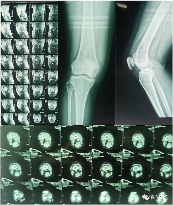 【优选病例】南华大学附属第一医院—肿瘤膝关节病例分享