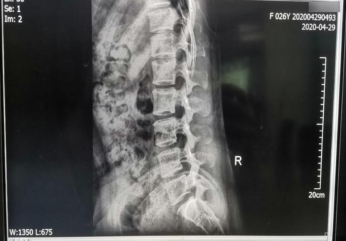 【康复之声】深层肌肉刺激仪在骨科疼痛中的临床应用