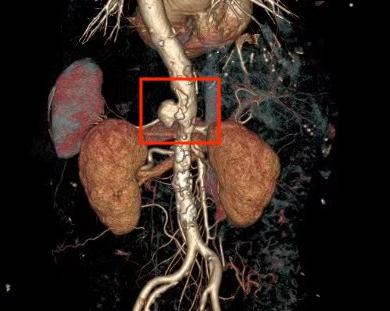 女子腹痛两个月，竟是腹主动脉夹层：国产升级“四开窗”挑战腔内治疗禁区