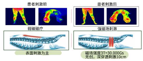 【康复之声】激光磁疗法—疼痛康复新技术