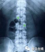 【产品推荐】腰椎椎弓根（Pedicle screw，PS）置钉技术