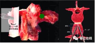 【产品推荐】腰椎椎弓根（Pedicle screw，PS）置钉技术