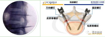 【产品推荐】腰椎椎弓根（Pedicle screw，PS）置钉技术