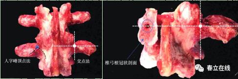 【产品推荐】腰椎椎弓根（Pedicle screw，PS）置钉技术