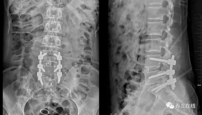 【产品推荐】腰椎椎弓根（Pedicle screw，PS）置钉技术