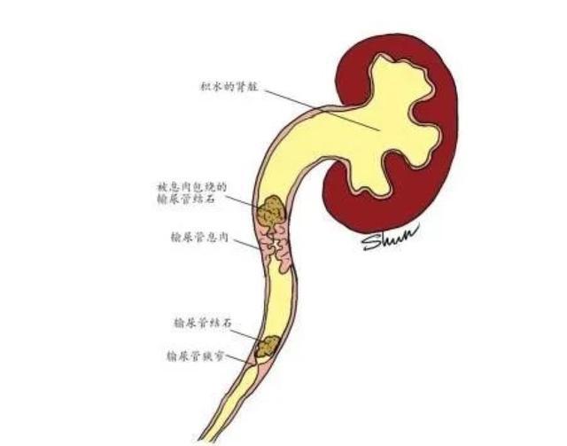 为什么会得肾结石？得了肾结石怎么办？跟着专家来解惑→