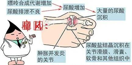 痛风知多少？快来看看金海街道这场社区健康讲座