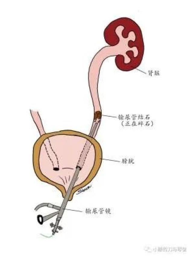 为什么会得肾结石？得了肾结石怎么办？跟着专家来解惑→