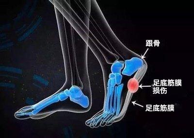 【康复之声】体外冲击波疗法在足底筋膜炎中的临床应用