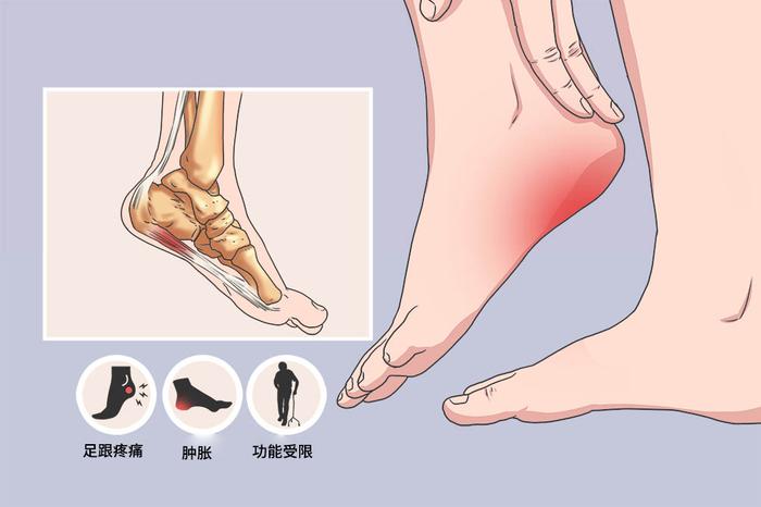 【康复之声】体外冲击波疗法在足底筋膜炎中的临床应用