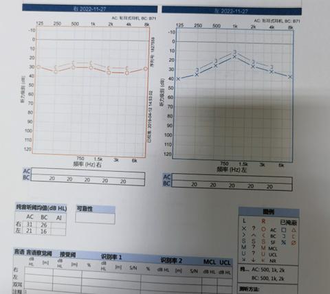 悦康通悦耳优秀病例7：突发性聋