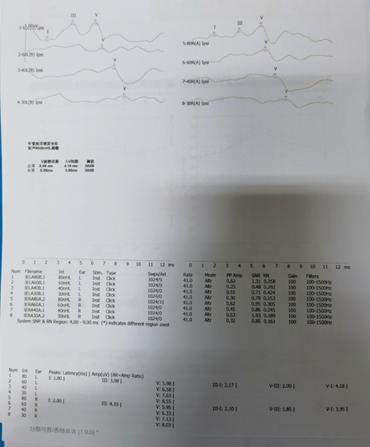 悦康通悦耳优秀病例7：突发性聋