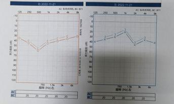 悦康通悦耳优秀病例7：突发性聋