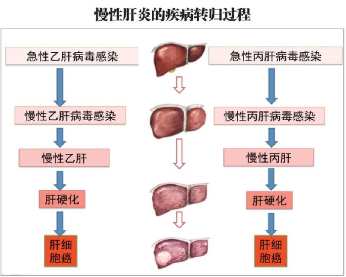 7月28日第十三个“世界肝炎日”——守护健康肝脏，为患者提供更好的治疗方案