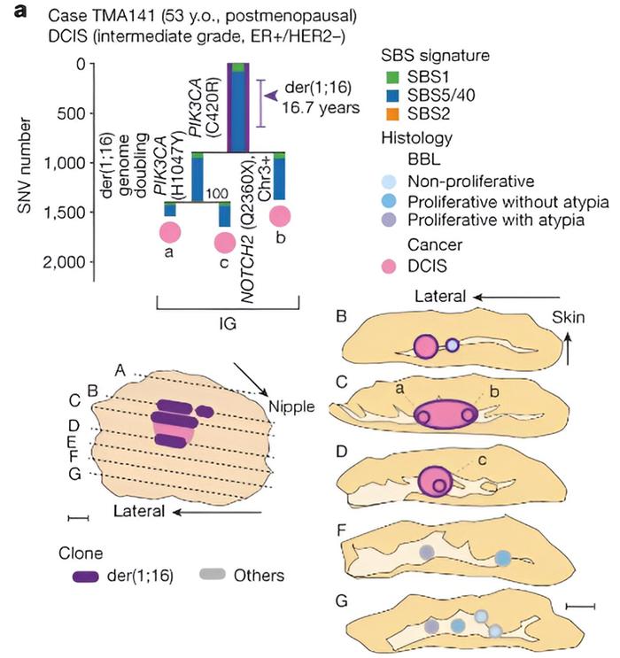 Nature | 挑战常规！乳腺癌具有多个独立癌症创始细胞是常见的！