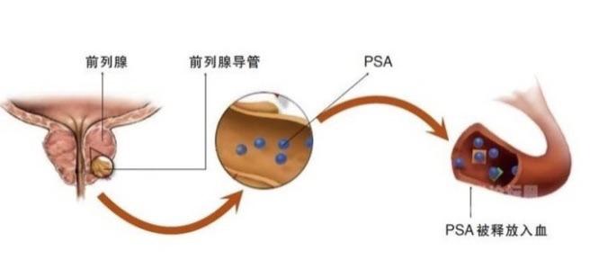 科普｜前列腺癌与PSA的前世今生