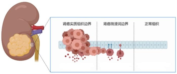 科普｜前列腺癌与PSA的前世今生