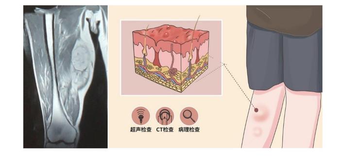 科普｜身上莫名其妙莫长了包怎么办？