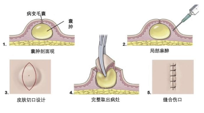 科普｜身上莫名其妙莫长了包怎么办？