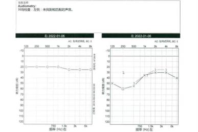 悦康通悦耳优秀病例8：高血压病3级突发性聋