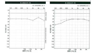悦康通悦耳优秀病例8：高血压病3级突发性聋