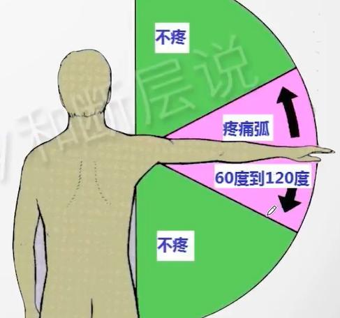 肩关节疼痛、活动受限不一定是肩周炎，而有可能是冈上肌损伤！