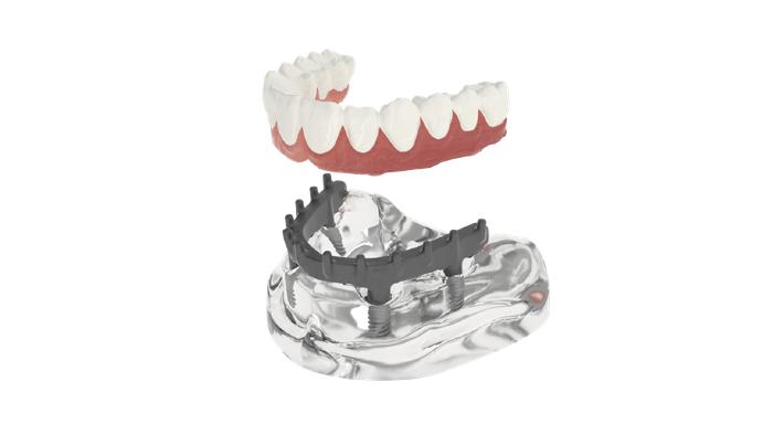 为广州市民提供高品质种牙解决方案丨柏德口腔“德国ROYAL半口即刻种植牙技术”