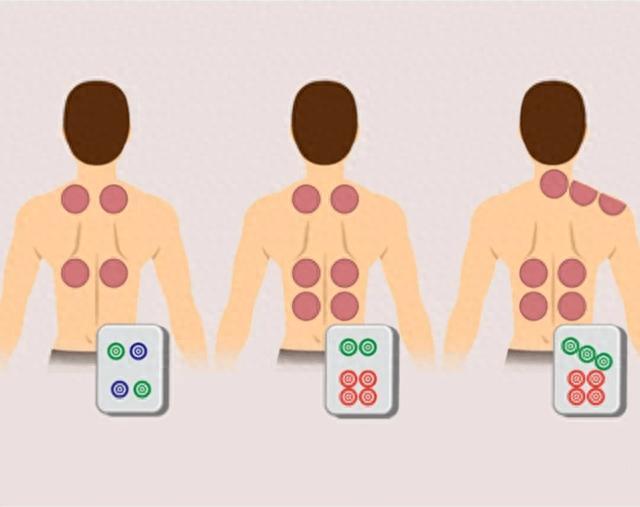 拔火罐吸出来的淤血，颜色越深“毒”越多？拔出水泡是湿气重？经常拔能减肥？真相来了→
