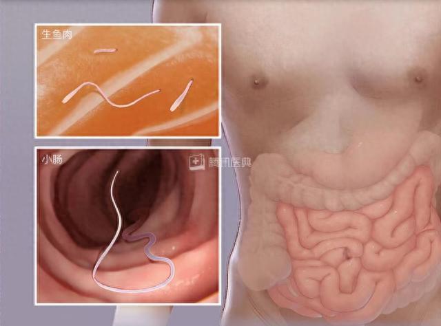 一口三文鱼刺身，医生从我肚子里拽出60cm活虫