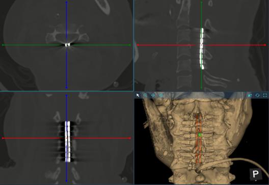 兰大二院神经外科开展一例高颈髓脊髓电刺激术促醒“植物人”手术
