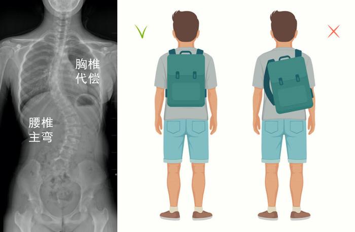 良医 | 背书包会引起脊柱侧弯吗？骨科医生教你选书包