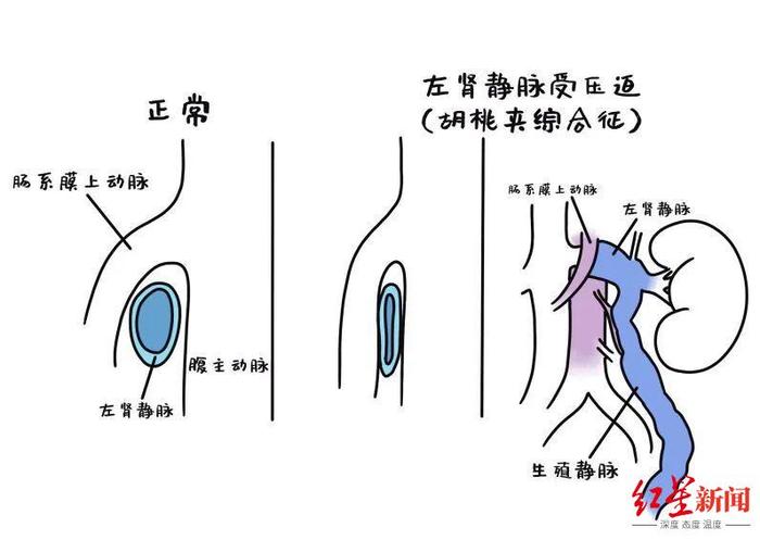 16岁少年患怪病喊了两年“下身痛”！医生：系胡桃夹综合征，多见于儿童青少年